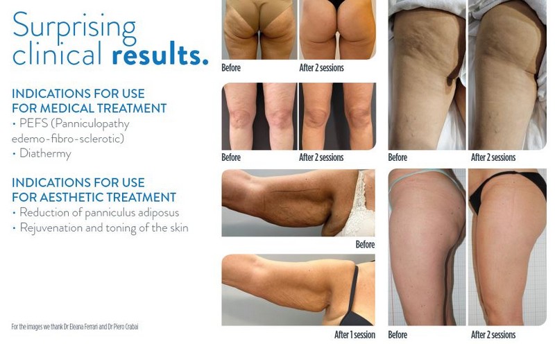 Lysiwave is an innovative system capable of performing body contouring treatments, using microwaves at a frequency of 2.45GHz